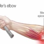 Golfers Elbow Treatment