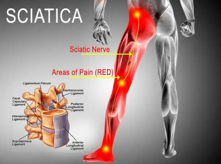 Back Pain Sciatic Nerve Pain