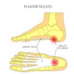 Plantar Fasciitis