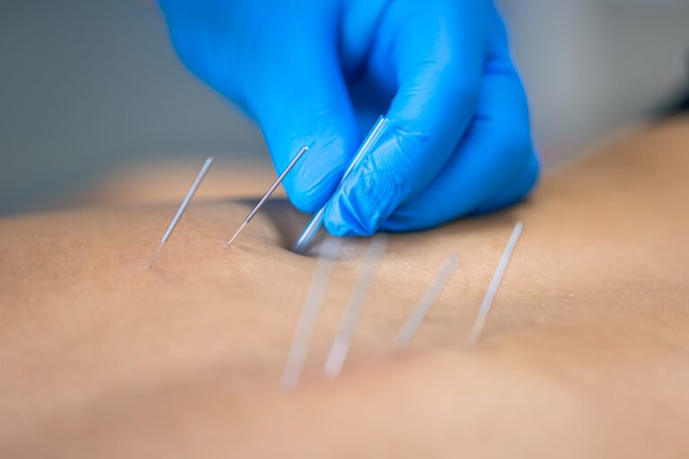 Dry Needling Therapy in Northern Kentucky